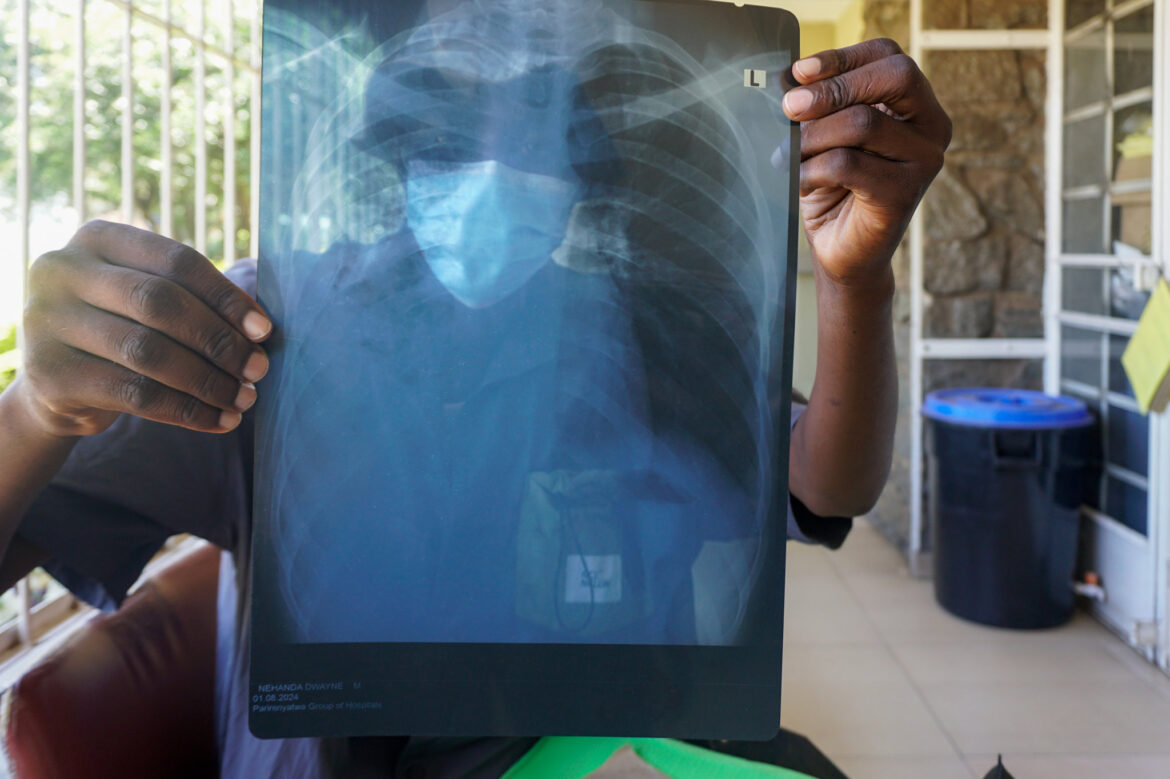 Dwayne Nehanda, a tuberculosis patient, receives chest X-ray results. Zimbabwe relies heavily on international funding for TB care, with USAID historically providing a major share of support.